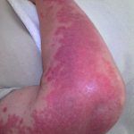 psoriasis